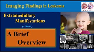 Leukemia Symptoms and Imaging Findings Video 1 [upl. by Reemas361]