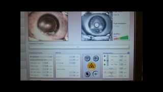 Pachymetry online for LASIK surgery to monitor corneal thickness [upl. by Lyris]