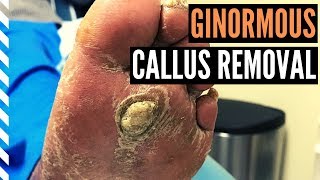 Ginormous Callus Removal [upl. by Krm861]