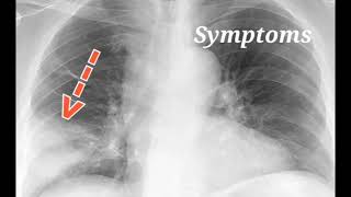 Lobar pneumonia  Symptoms Treatment and prevention [upl. by Louie]