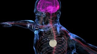 Vagus Nerve Stimulation A novel treatment for PraderWilli Syndrome [upl. by Deach]