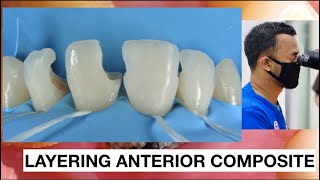 Step by step Layering Anterior Composite  General Dentist Griya RR [upl. by Swayne]