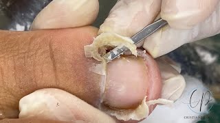 SUPER SATISFATÓRIO🤤  CRISTIANE PORTO PODÓLOGA satisfying ingrowntoenail [upl. by Nonek]