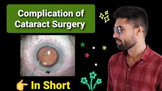 Complication of cataract surgery lecture opthalmology [upl. by Nilyaj384]