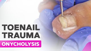 Toenail Trauma  Onycholysis  Cleanup [upl. by Clabo]