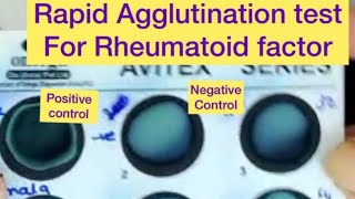 Rapid Agglutination test for Rheumatoid factor [upl. by Toffey163]