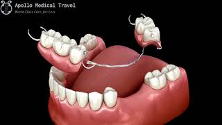 Animated Removable Partial Dentures  Apollo Medical Travel [upl. by Susanetta]