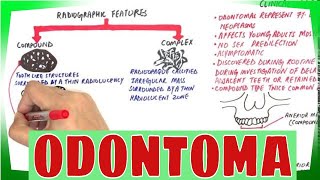 Odontoma  Types Clinical features Histopathological Features amp Treatment [upl. by Uolymme297]