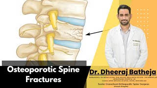 Transform Your Understanding of Osteoporotic Spine Fractures with Dr Dheeraj Batheja [upl. by Nalyd]