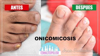 Onicomicosis Eliminar hongo de las uñas  Esmalteopolish [upl. by Wakefield]