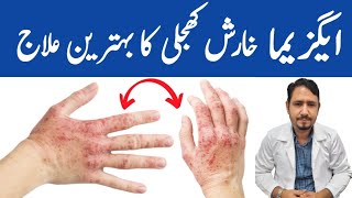 Magical Remedy For Eczema  Irfan Azeem [upl. by Auqenet]