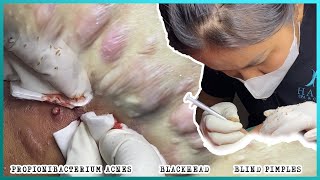 Big Cystic Acne Blackheads Extraction Blackheads amp Milia Whiteheads Removal Pimple Popping [upl. by Ardyth]