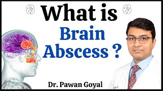 What is brain abscess   Causes Symptoms and Lifesaving Treatments  Dr Pawan Goyal [upl. by Repsag]