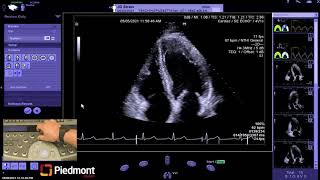 Piedmont Healthcare Left Ventricle Myocardial Strain Workflow on Siemens SC2000 [upl. by Carper893]