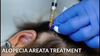 PRP Stem Cells amp Steroid Injections for Alopecia Areata Female Hair Loss Treatment  Dr Jason Emer [upl. by Knorring12]