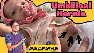 BABY UMBILICAL HERNIA Video 2 [upl. by Dosia]