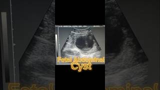 Anomaly Scan  Anomaly Ultrasound  Fetal Cyst  Oligohydramnios on Ultrasound [upl. by Nelak565]