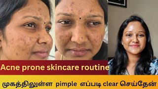 How I cleared my acne  Acne prone skincare routine  Products that I used for acne acneproneskin [upl. by Nattie]