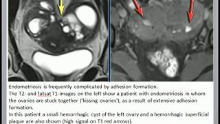 Endometriosis MRI detection of the endometriosis [upl. by Landau]