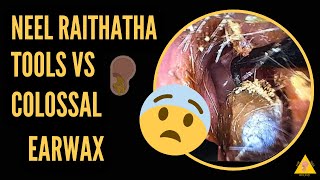 Ear wax doctor wax medicine ear wax removal human body ear cleaning ear cleaning asmr [upl. by Tabshey725]