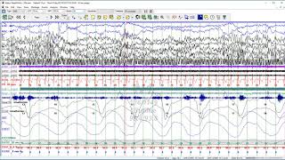 Natus EEGPSG Tutorial NeuroWorksSleepWorks 9 Traces Visualization [upl. by Gorlin442]