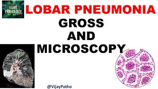 Lobar Pneumonia  Pathology  Gross and Microscopy  Illustration  Draw With Me [upl. by Melicent]