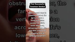 The First Successful Cesarean Section in History shorts [upl. by Levins]