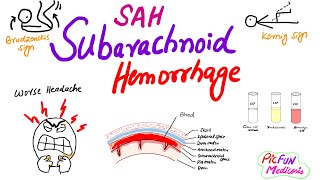 Subarachnoid Hemorrhageberry aneurysmSAHNeurosurgery [upl. by Ong]