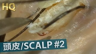 2 Scalp Blackhead Removal Close up HQ200X [upl. by Olram]