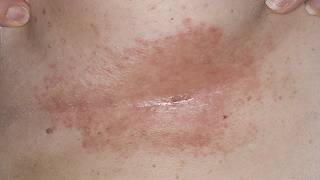 DermTV  How to Treat Under Breast Rashes amp Infections DermTVcom Epi 190 [upl. by Luapnoj]