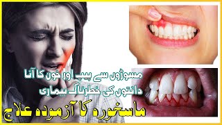 Pyorrhea Treatment Home Remedy  ماسخورہ کا علاج  Farzeen Beauty Hub [upl. by Garzon821]