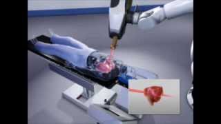 CyberKnife vs IMRT IGRT RapidArc for Treating Lung Cancer [upl. by Anihta]