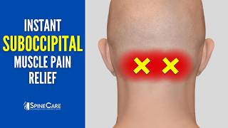 How to Fix Suboccipital Pain in 30 SECONDS Base of Skull Pain Relief [upl. by Adnahsam646]