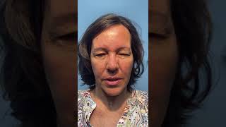 Patient with Meige syndrome facial spasms being treated with Botox [upl. by Nixie]