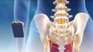 Overview of Sacral Nerve Stimulation for Urinary Control [upl. by Nuahsyd]