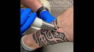 Advanced Dermatology safely and effectively removes tattoos with laser technology [upl. by Klingel]