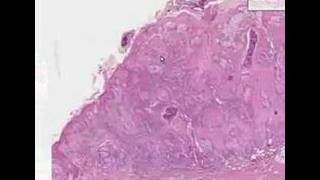 Histopathology Skin Squamous cell carcinoma [upl. by Rimaa]