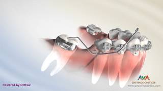 Orthodontic Treatment for Molar Uprighting  Cantilever Spring [upl. by Llerat]