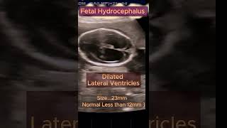 Fetal Hydrocephalus with Spine normal ultrasound pregnancy congenital hydrocephalus [upl. by Iroc]