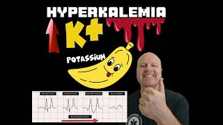 Why Hyperkalemia causes a widened QRS complex on the ECG  Explained [upl. by Llenad]