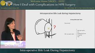 Intraoperative Bile Leak During Hepatectomy [upl. by Krm]