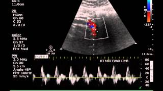 Ultrasound Assessment of an Aortic Endogrft  Case Study [upl. by Aem]