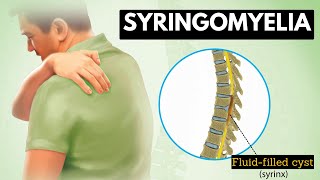 Syringomyelia Everything You Need To Know [upl. by Jannelle]