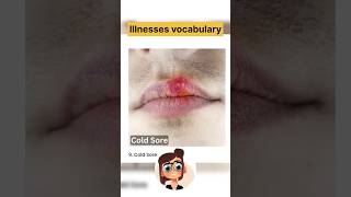 Illnesses vocabulary in English learnenglish englishspeaking storytimeforkids [upl. by Kamp]