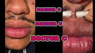 REMOVING INFECTED INGROWN HAIR 17 [upl. by Lorena5]