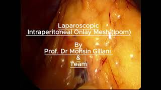 Laparoscopic Intraperitoneal Onlay Mesh IPOM [upl. by Handy]