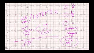 IM Cardiology 4 Ischemic Heart Disease IHD Acute Coronary Syndrome ACS UANSTEMI [upl. by Giguere985]