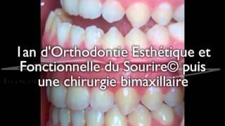 Chirurgie bimaxillaire pour un jeune adulte  correction avec 1an daligneurs® en OEFS© [upl. by Arbas]