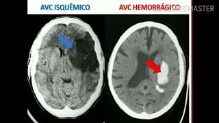 AVCH E AVCI  Saiba a diferença do AVC isquêmico e o AVC hemorrágico  Derrame cerebral [upl. by Llerehc]