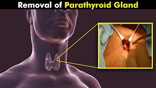 How Parathyroid Gland Surgery Is Performed UrduHindi [upl. by Gautea]